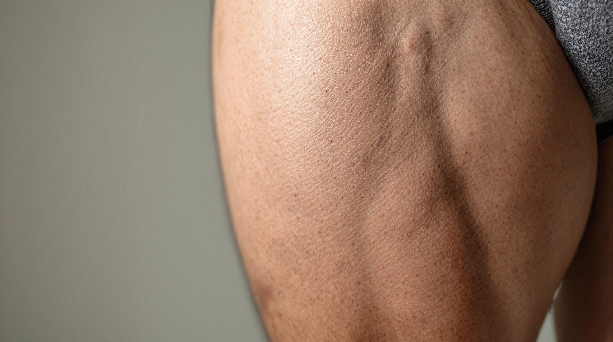 Vergetures sur les cuisses chez les hommes : causes, traitements et prévention - Mode Reine
